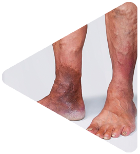 Archana hospital service for VARICOSE VEIN
